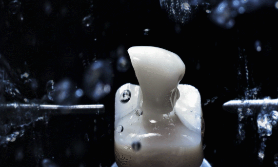 Animation de couronne dentaire